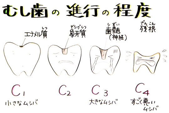 むし歯の進行の程度