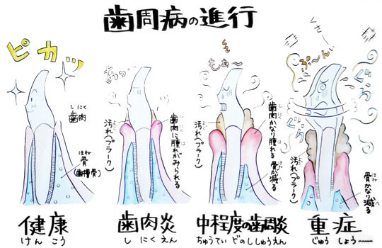 歯周病の進行