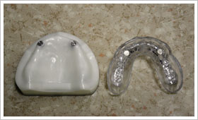 マグネット（磁性アタッチメント）義歯