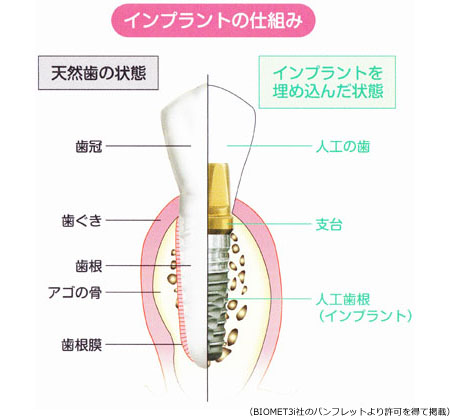 インプラントの仕組み